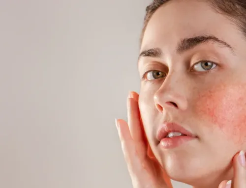 Rosacea en Roodheid behandelen